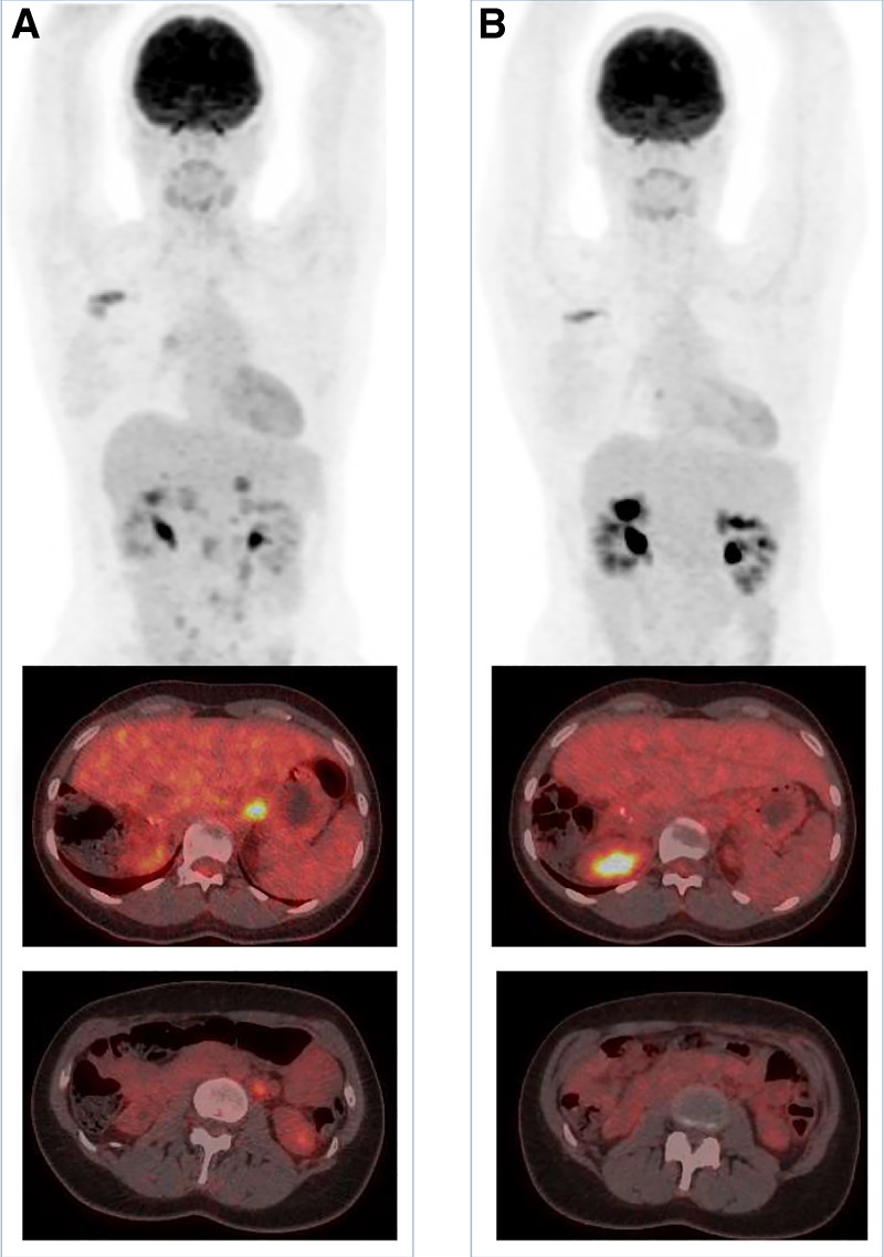 <i>PIK3CA</i> copy-number gain and inhibitors of the PI3K/AKT/mTOR pathway in triple-negative breast cancer.