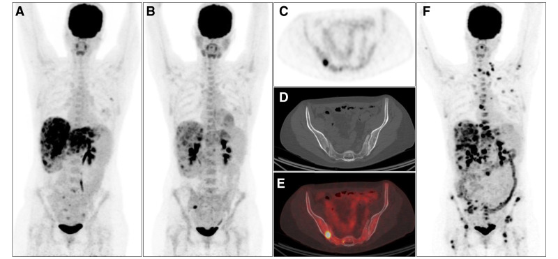 <i>PIK3CA</i> copy-number gain and inhibitors of the PI3K/AKT/mTOR pathway in triple-negative breast cancer.