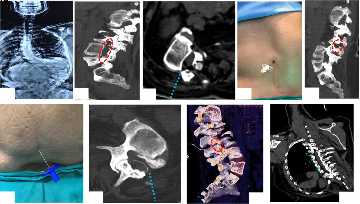 Intervertebral Foramen - A Gateway to Epidural Space in Severe Lumbar Scoliosis.