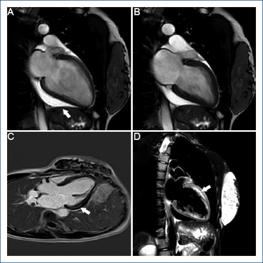 [Preeclampsia and segmental contractility disorders, a rare scenario].