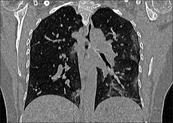 Acute acalculous cholecystitis as a rare gastroenterological association of COVID-19: a case series and systematic review.