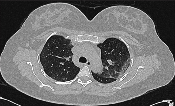 Acute acalculous cholecystitis as a rare gastroenterological association of COVID-19: a case series and systematic review.