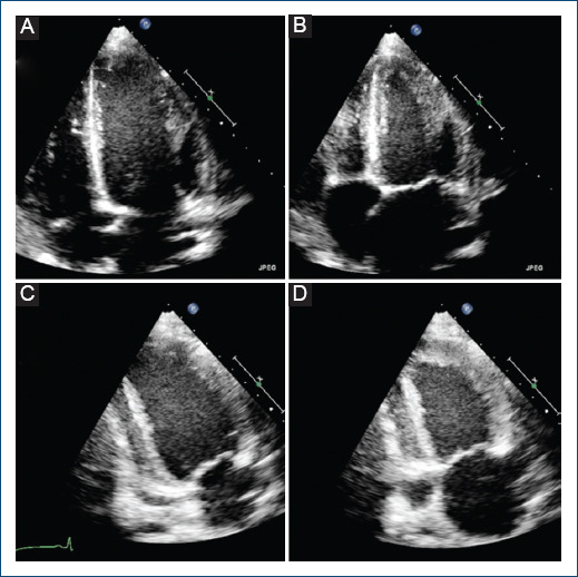 [Preeclampsia and segmental contractility disorders, a rare scenario].