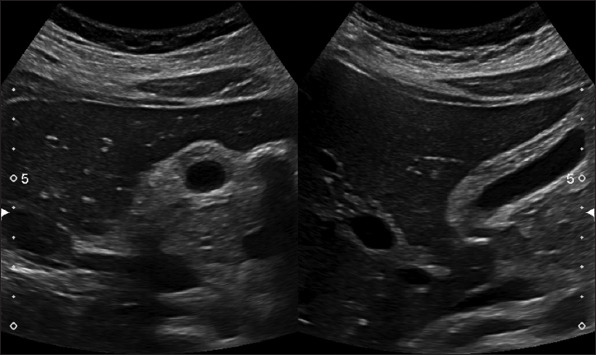 Acute acalculous cholecystitis as a rare gastroenterological association of COVID-19: a case series and systematic review.