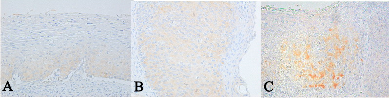 Clinical and Morphological Study of Cervical Squamous Intraepithelial Lesions.