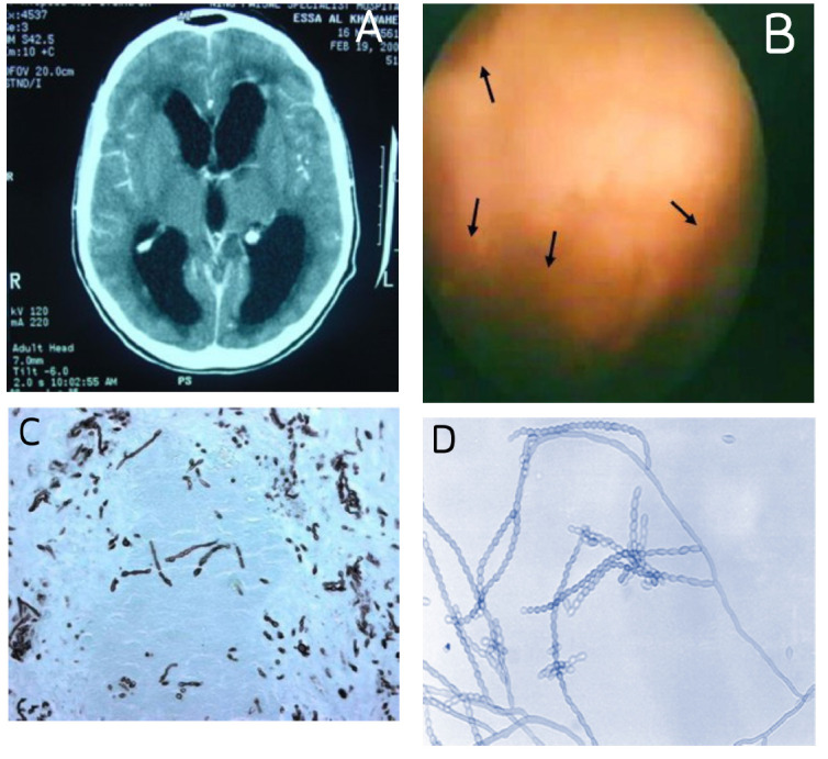 Cerebral phaeohyphomycosis at a tertiary healthcare center in Saudi Arabia.