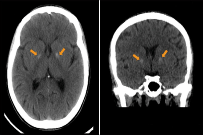 Catatonia revealing a Fahr syndrome.