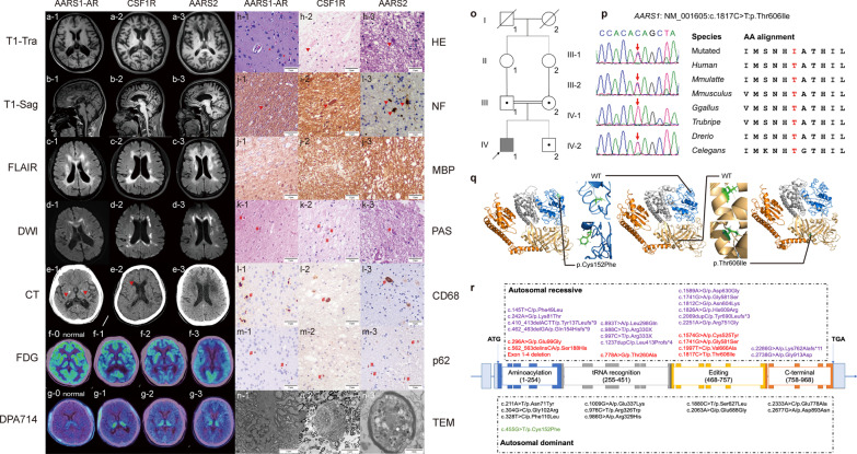 An AARS1 variant identified to cause adult-onset leukoencephalopathy with neuroaxonal spheroids and pigmented glia.