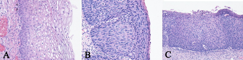 Clinical and Morphological Study of Cervical Squamous Intraepithelial Lesions.