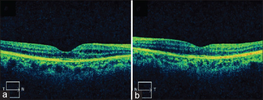 Latanoprost-associated cystoid macular edema in a patient with phakic eyes.