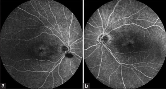 Latanoprost-associated cystoid macular edema in a patient with phakic eyes.