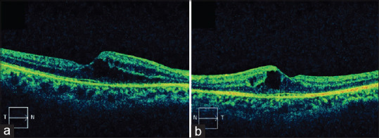 Latanoprost-associated cystoid macular edema in a patient with phakic eyes.