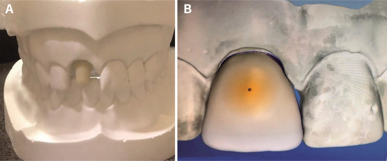 The effects of cement thickness and cement shade on the final color of lithium disilicate crowns.