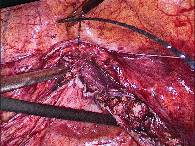 Vaginal Vault Infiltration with Bupivacaine for Postoperative Pain Control after Total Laparoscopic Hysterectomy: A Randomized control trial.