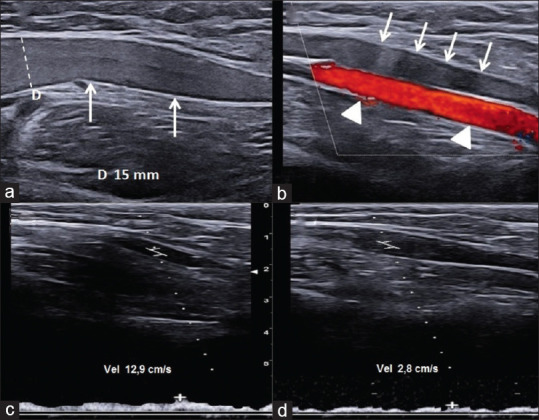 The Role of Ultrasound in Venous Thoracic Outlet Syndrome: Lesson Based on a Case Report.