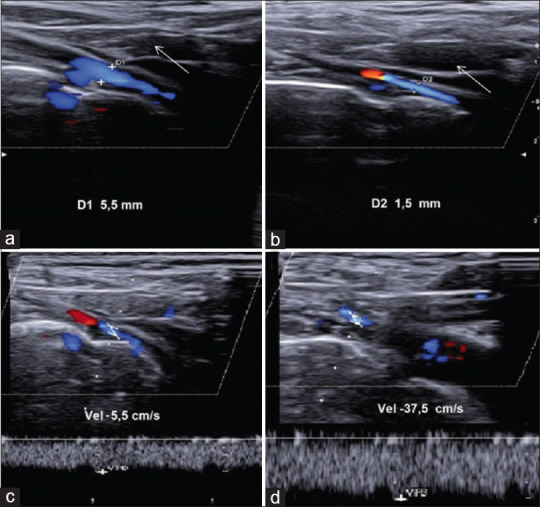 The Role of Ultrasound in Venous Thoracic Outlet Syndrome: Lesson Based on a Case Report.