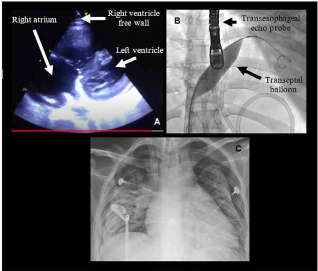 Sulfonamide-induced acute eosinophilic pneumonia requiring extracorporeal membrane oxygenation support: a case report.