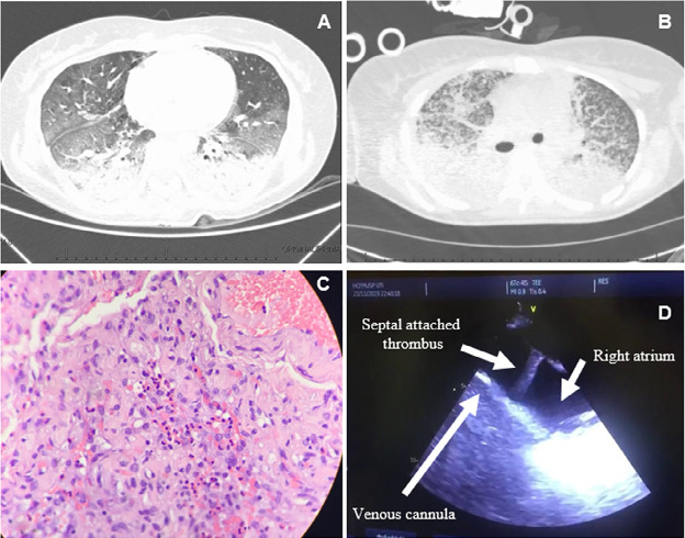 Sulfonamide-induced acute eosinophilic pneumonia requiring extracorporeal membrane oxygenation support: a case report.