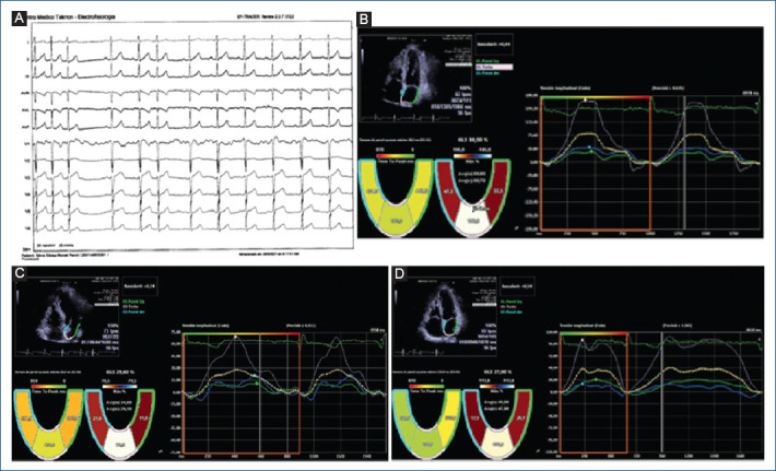 Assessment of short forms of recurrent atrial extra systoles by echocardiography with left atrial strain in ambulatory patients without organic cardiopathy.