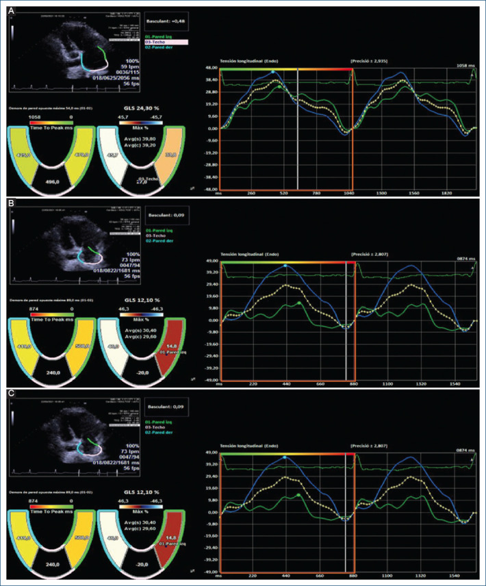 Assessment of short forms of recurrent atrial extra systoles by echocardiography with left atrial strain in ambulatory patients without organic cardiopathy.