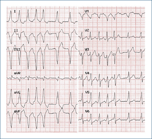 Alternating right bundle branch block or intermittent preexcitation?