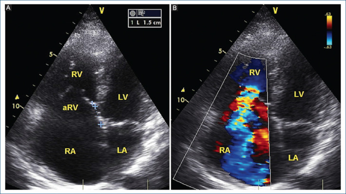 Alternating right bundle branch block or intermittent preexcitation?