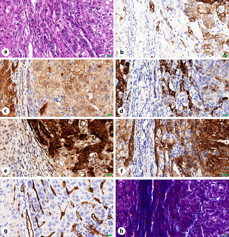 Combined Hepatocellular-Cholangiocarcinoma: Biology, Diagnosis, and Management.