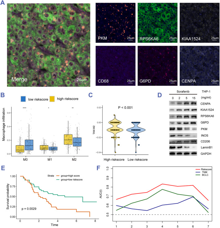 TP53 mutation-related senescence is an indicator of hepatocellular carcinoma patient outcomes from multiomics profiles.