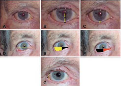 Short-term qualitative and quantitative analyses of preseptal injection of hyaluronic acid on the treatment of acquired lower eyelid cicatricial ectropion.
