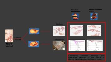 Identification of Carotid Plaques Composition Through a Compact CSRR-Based Microwave Sensor