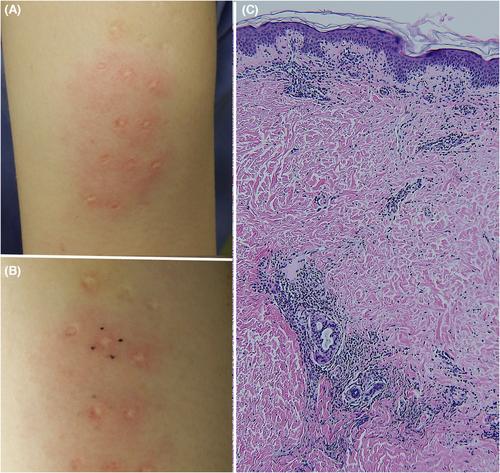 Erythematous reaction of the BCG site to Pfizer-BioNTech COVID-19 vaccine