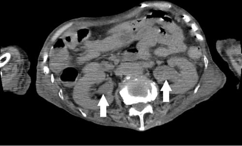 A case of gangrenous cystitis with bilateral hydronephrosis 10 years after radiotherapy