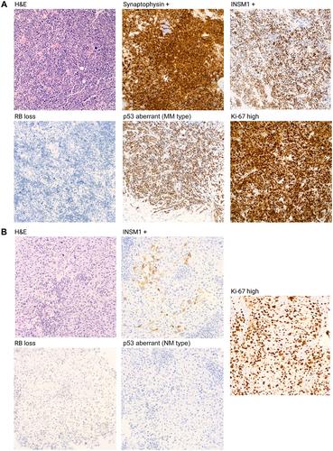 Defining triple-negative breast cancer with neuroendocrine differentiation (TNBC-NED)