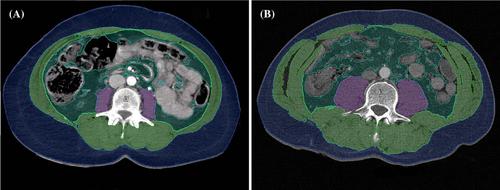 Predictive influence of artificial intelligence-based body composition analysis in trauma patients with pelvic injuries