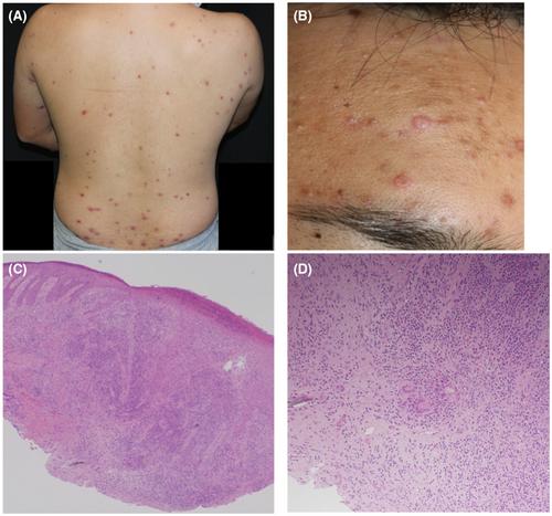 Granulomatous reaction as a postherpetic isotopic response after primary varicella infection in a healthy adult