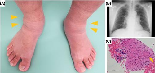 Acute arthritis caused by sarcoidosis