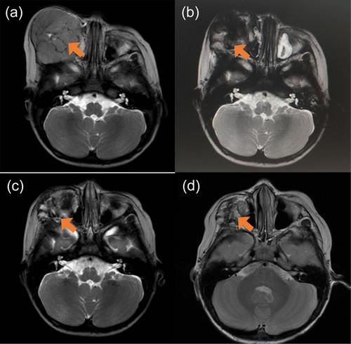 Particle implantation combined with chemotherapy for rhabdomyosarcoma of the head and neck: A 8-year long-term follow-up case report