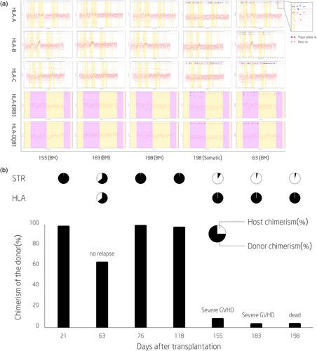 Severe graft-versus-host disease post allogeneic hematopoietic stem cell transplantation due to loss of HLA heterozygosity in recipient lymphocytes after full graft rejection