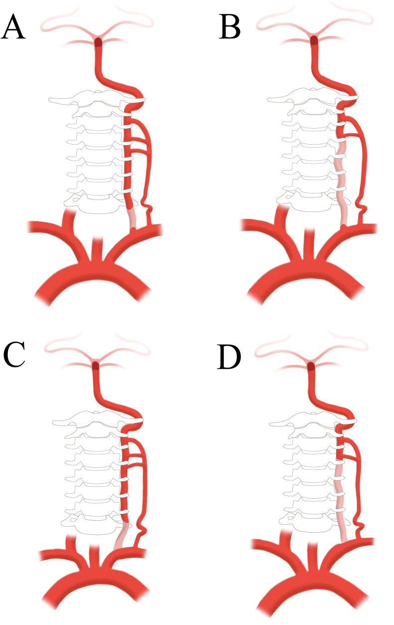 Comprehensive classifications for the endovascular recanalization of vertebral artery stump syndrome