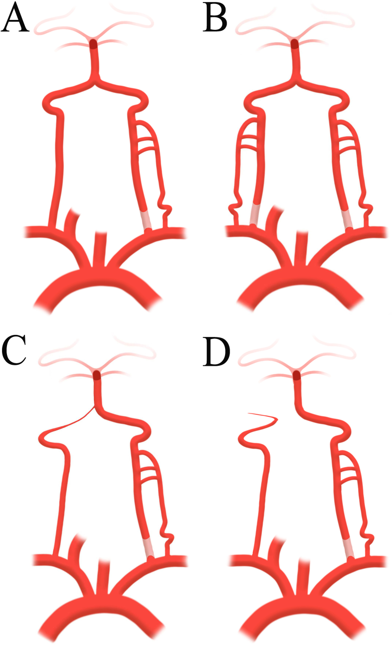 Comprehensive classifications for the endovascular recanalization of vertebral artery stump syndrome