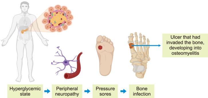 Diabetic Pedal Osteomyelitis and Its Treatment.