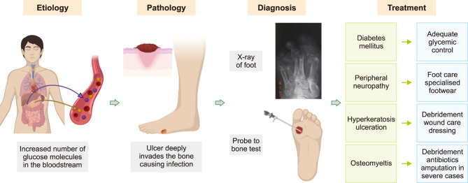 Diabetic Pedal Osteomyelitis and Its Treatment.