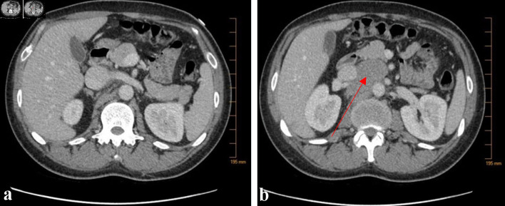 Vanishing Bile Duct Syndrome in a Patient With Recurrent Hodgkin Lymphoma.