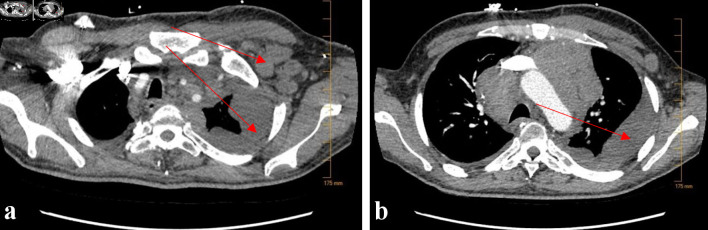 Vanishing Bile Duct Syndrome in a Patient With Recurrent Hodgkin Lymphoma.