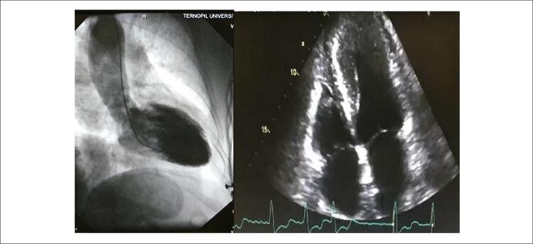 MINOCA Phenotypes - A Challenge for Patient-Specific Management.