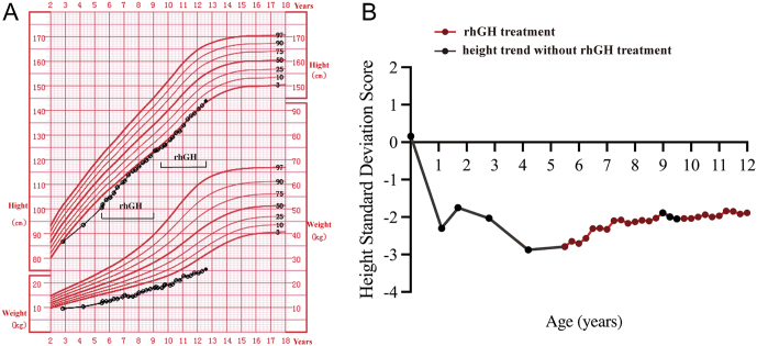 CTCF variant begets to short stature by down-regulation of IGF1.