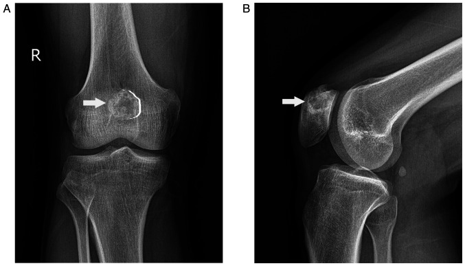 Osteoblastoma of the patella, a rare benign bone tumor with an uncommon site: A case report.