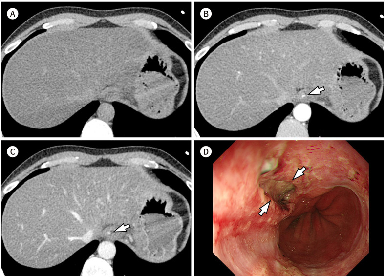 [Radiologic Diagnosis of Gastrointestinal Bleeding].