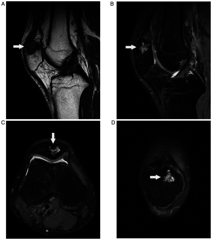 Osteoblastoma of the patella, a rare benign bone tumor with an uncommon site: A case report.