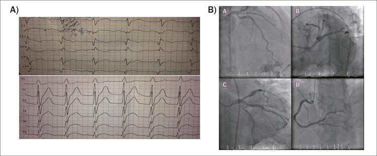 MINOCA Phenotypes - A Challenge for Patient-Specific Management.